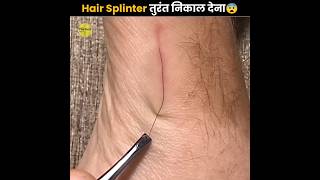 Remove Hair Splinter Immediately⚠️ [upl. by Leviram]