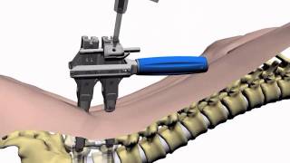 Perkutane minimalinvasive Versteifung der Lendenwirbelsäule [upl. by Jaehne]