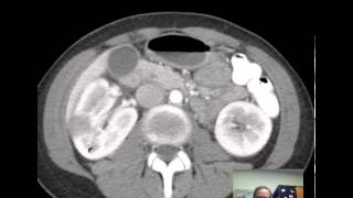 CT Kidneys and Bladder  Five pathologic cases discussed [upl. by Retepnhoj616]