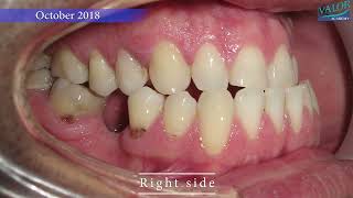 😲 JAW SURGERY and WISDOM teeth management 🦷💕 [upl. by Eyssej]