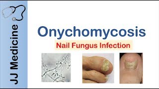 Onychomycosis  Nail Infection  Signs Symptoms Treatment [upl. by Lebazej]