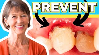 How To Treat Gingivitis And Gum Recession At Home [upl. by Willin140]