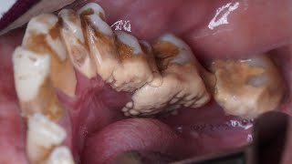 Deep Cleaning With HEAVY Tartar Build Up At The Dentist [upl. by Vassily865]