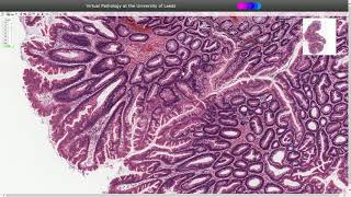 Traditional Serrated Adenoma  Histopathology [upl. by Haimehen]