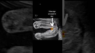 Ultrasound Scan Showing Baby Girl 👧 oldwivestales status pregnancy educational [upl. by Vasiliu957]