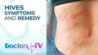 Hives Symptoms and Remedy  DOTV [upl. by Anomor]