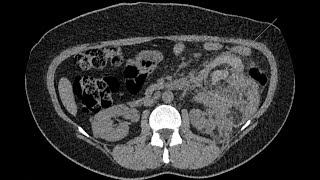 Hemorrhagic renal angiomyolipoma in a tuberous sclerosis phakomatosis patient [upl. by Darren]