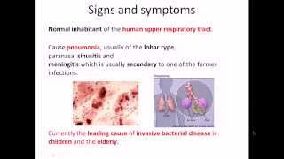 Streptococcus pneumoniae infection and disease [upl. by Aivin]