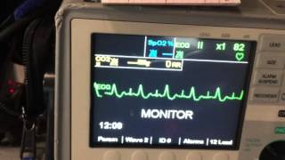 Sick Sinus Syndrome [upl. by Ellennoj390]