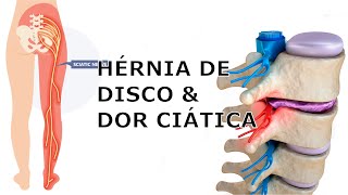 Como Aliviar a Dor na Crise de Hérnia de Disco ou Ciático Dicas Práticas de um Fisioterapeuta [upl. by Id]