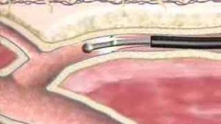 Varicose Veins Closure Procedure at BIDMC [upl. by Isabea]