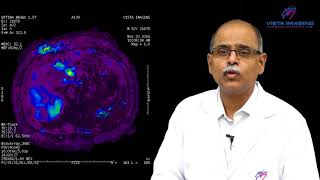 MR Elastography for Liver diseseas [upl. by Iramaj]