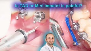 Patient feelings after tads insertion amp 1 week later screwing in ortho miniimplantes miniscrew [upl. by Beatrice]