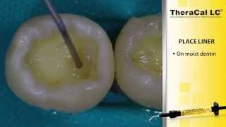 Direct Composite Placement Using TheraCal LC and AllBond Universal [upl. by Reagen437]