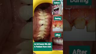 Smile transformation with Zirconia crown in just 24 hoursa patient from USA [upl. by Gawain]