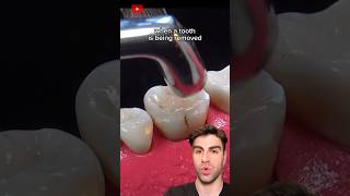 Tooth Extraction The ACTUAL Process Explained [upl. by Philippine]