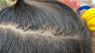 Remove thousand lice from black hair  Getting out all head lice from hair [upl. by Laehcim]