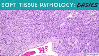 Basic Soft Tissue Pathology Cases Explained by a Sarcoma Pathologist [upl. by Eniretac89]