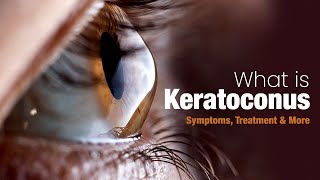 What is Keratoconus  Symptoms Treatment and More [upl. by Yttig]