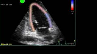 ABNORMAL STRAIN LONGITUDINAL ECHO [upl. by Ayhay]