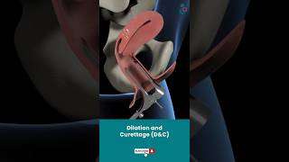 Dilation And Curettage DampC  Fertility Treatment ↪3D Medical Animation Shorts DilationampCurettage [upl. by Culley116]