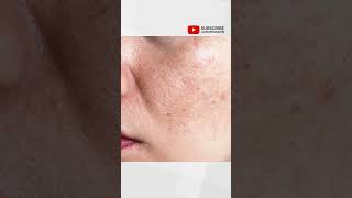 Top Mistake Triggering Melasma [upl. by Ataymik747]