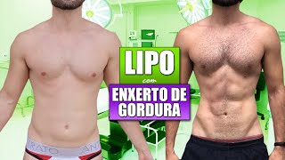 ANTES E DEPOIS DA LIPOESCULTURA COM ENXERTO NO PEITORAL  CIRURGIA PLÃSTICA [upl. by Alauqahs]