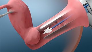 Pruebas de Papanicolaou y VPH [upl. by Mureil]