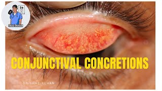 Conjunctival Concretions What are they Eye Dr Explains [upl. by Vadnee252]