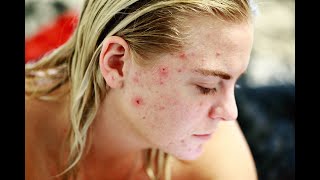 How to Get Rid of Acne Acne Treatments That Work Popular acne treatments most effective face [upl. by Ettigirb21]