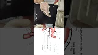 Anastomosis between celiac artery amp superior mesenteric artery Pancreaticoduodenal arteries short [upl. by Borman]