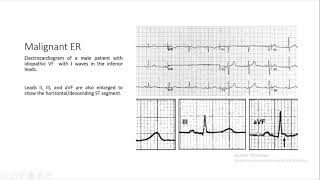 early repolarization [upl. by Ghassan]