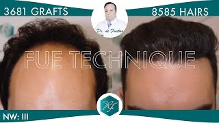 Injerto Capilar Técnica FUE – 3681 Grafts 8585 Pelos – Dr Rafael de Freitas [upl. by Anitnamaid]