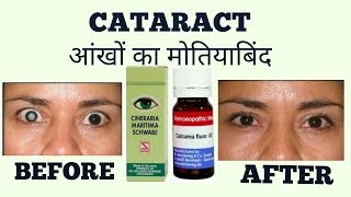 CATARACTआँखों का मोतियाबिंद HOMOEOPATHIC TREATMENT [upl. by Shantee]