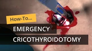 Emergency Cricothyroidotomy using CricKey [upl. by Ayala401]