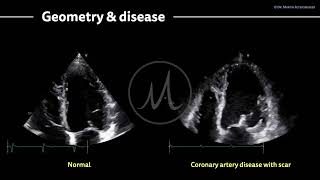 〖Echocardiography〗 Coronary artery disease amp the left ventricle ❤️‍🩹 [upl. by Nilesoj]