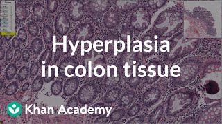 Hyperplasia in colon tissue  Gastrointestinal system diseases  Health amp Medicine  Khan Academy [upl. by Damalis600]