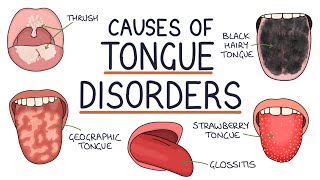 Understanding Tongue Disorders Causes and Management [upl. by Yatnahc]