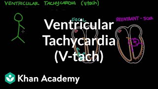 Ventricular tachycardia Vtach  Circulatory System and Disease  NCLEXRN  Khan Academy [upl. by Nalliuq]