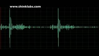 Takotsubo Cardiomyopathy [upl. by Redliw]