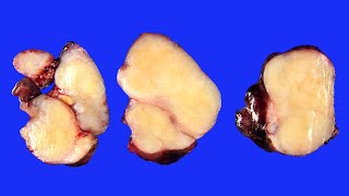 Three cases of calcifying fibrous tumor [upl. by Mchail]