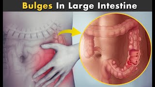 Diverticulosis And Diverticulitis  Symptoms Causes And Treatment [upl. by Yarezed]