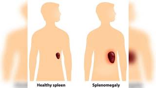 La splénomégalie [upl. by Kruter]