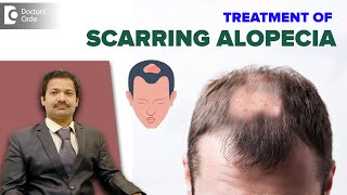 SCARRING ALOPECIA Treatment  Patchy Hair Loss amp Hair RegrowthDrDeepak P Devakar Doctors Circle [upl. by Chadbourne]