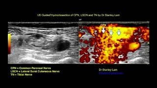 Ultrasoundguided nerve hydrodissection for pain management – Supplementary video 6 ID 247208 [upl. by Luckett]