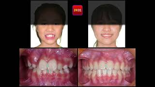 Molar Ankylosis｜【Chris Chang Ortho】CC796 [upl. by Melar]