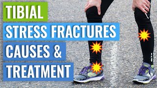 Tibial Stress Fractures  Treatment amp Healing Times [upl. by Ttayh407]