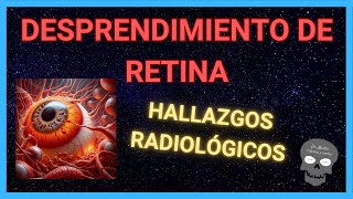 DESPRENDIMIENTO DE RETINA Hallazgos Radiológicos 👁️ [upl. by Ebsen]