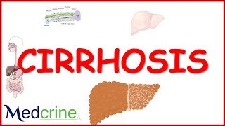 LIVER CIRRHOSIS causespathophysiologyfeaturesdiagnosistreatment [upl. by Myk]