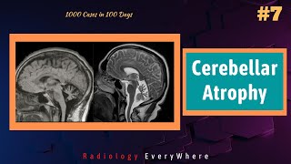 Causes for Cerebellar Atrophy  Radiology tutorials  1000 cases in 100 days  Video 7 [upl. by England92]